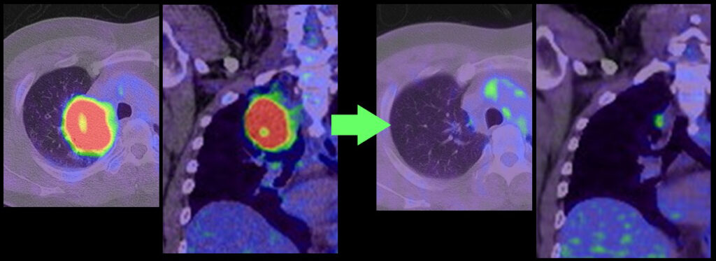 呼吸器外科部 – 愛知県がんセンター