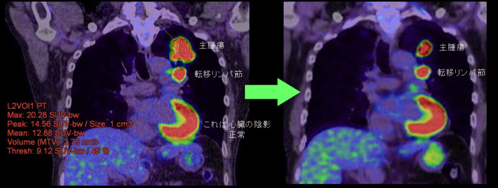呼吸器外科部 – 愛知県がんセンター